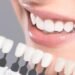 Veneer Gigi:
