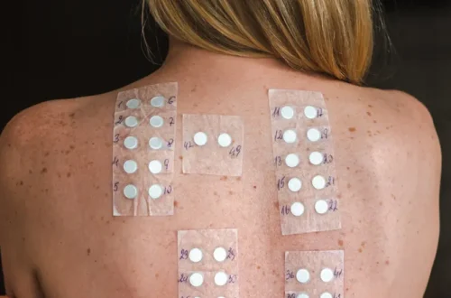 Patch Test: