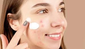 Skincare untuk Kulit Berjerawat: