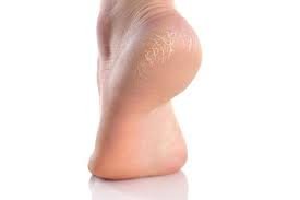 Cara Menghilangkan Kulit Kaki yang Kering dan Pecah-pecah