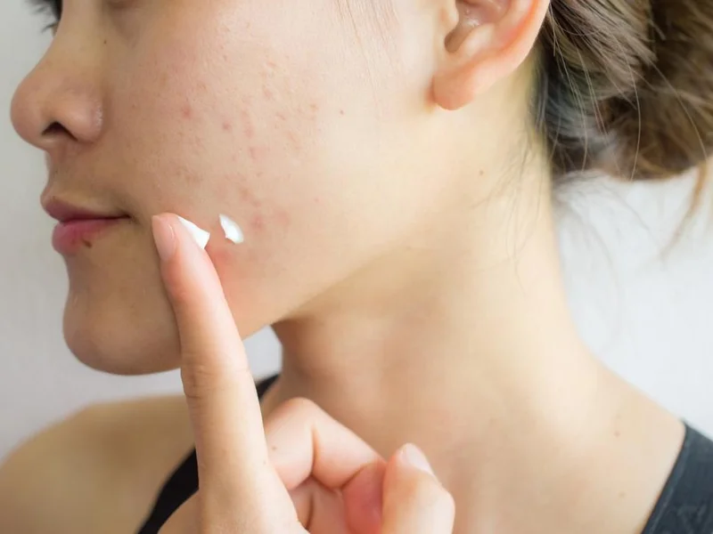 Cara Menghilangkan Bekas Jerawat dengan Skincare yang Tepat