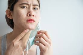 Jerawat karena Masker (Maskne):